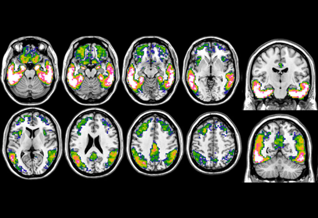 Tau imaging with 18F-Flortaucipir PET in Alzheimer’s disease. The figure shows a prototypical tau accumulation pattern, obtained by comparing tau load of patients with Alzheimer’s disease vs healthy controls. The blue-to-white color scale indicates more pronounced tau loads, with pink-white areas representing those with the highest accumulation.