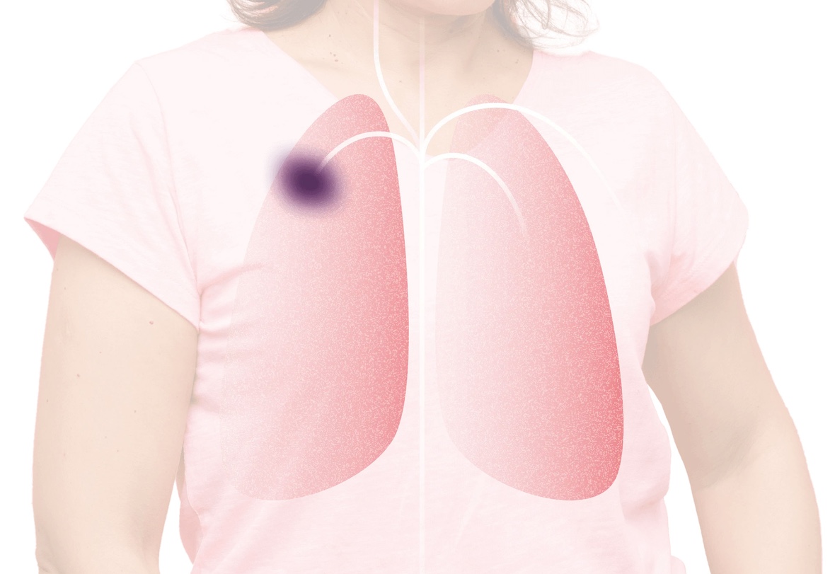 Hedera Dx a levé EUR 15 millions pour développer ses diagnostics oncologiques en milieu hospitalier et rendre l'oncologie de précision plus accessible aux patients du monde entier.