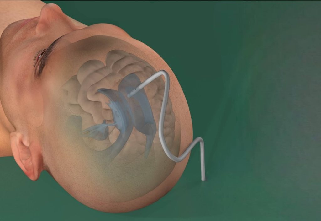La medtech bernoise Rhovica Neuroimaging a levé CHF 2,3 millions pour accélérer le développement de son système SoNav destiné à sécuriser la neurochirurgie d’urgence.